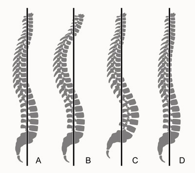 Errores de postura y defectos de columna vertebral: hiperlordosis e hipercifosis.