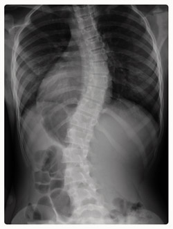Radiografía de la columna vertebral con escoliosis. Los ejercicios del video curso muestran un ejemplo de cómo se puede aliviar el efecto fortaleciendo los músculos y corrigiendo la postura.